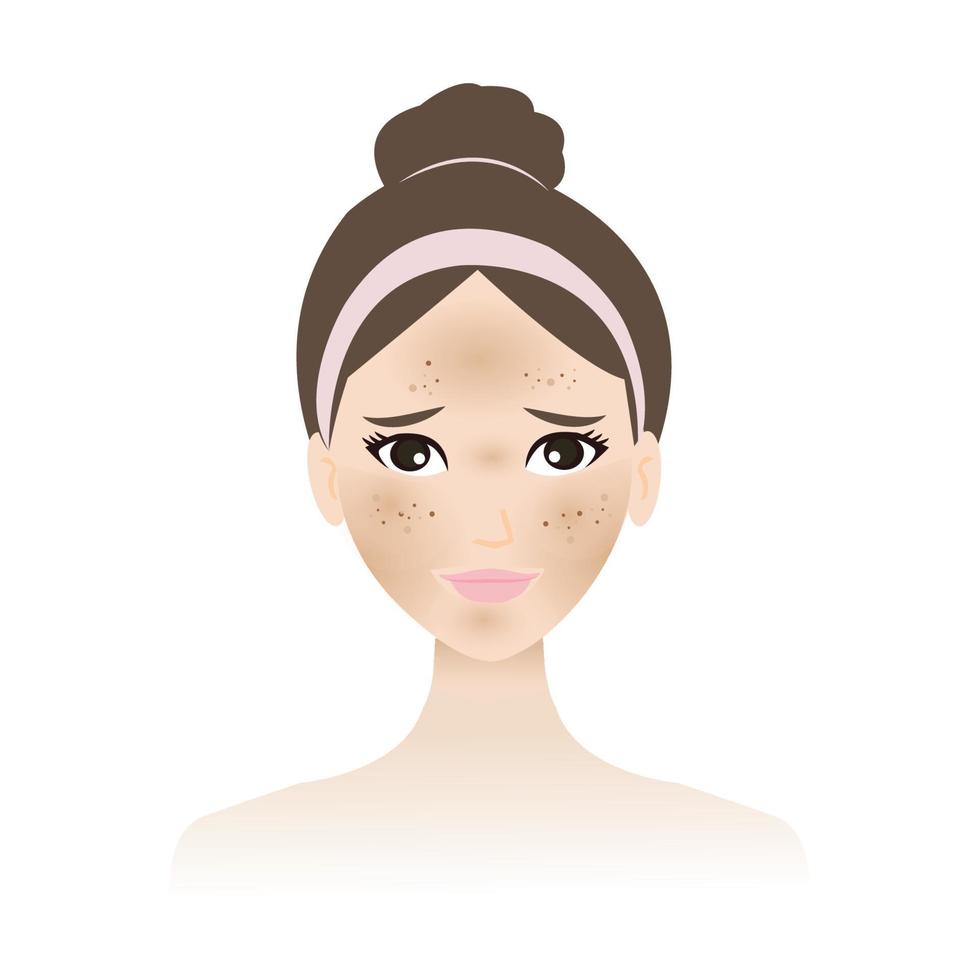 Hyperpigmentation - Guide for Glowing Skin