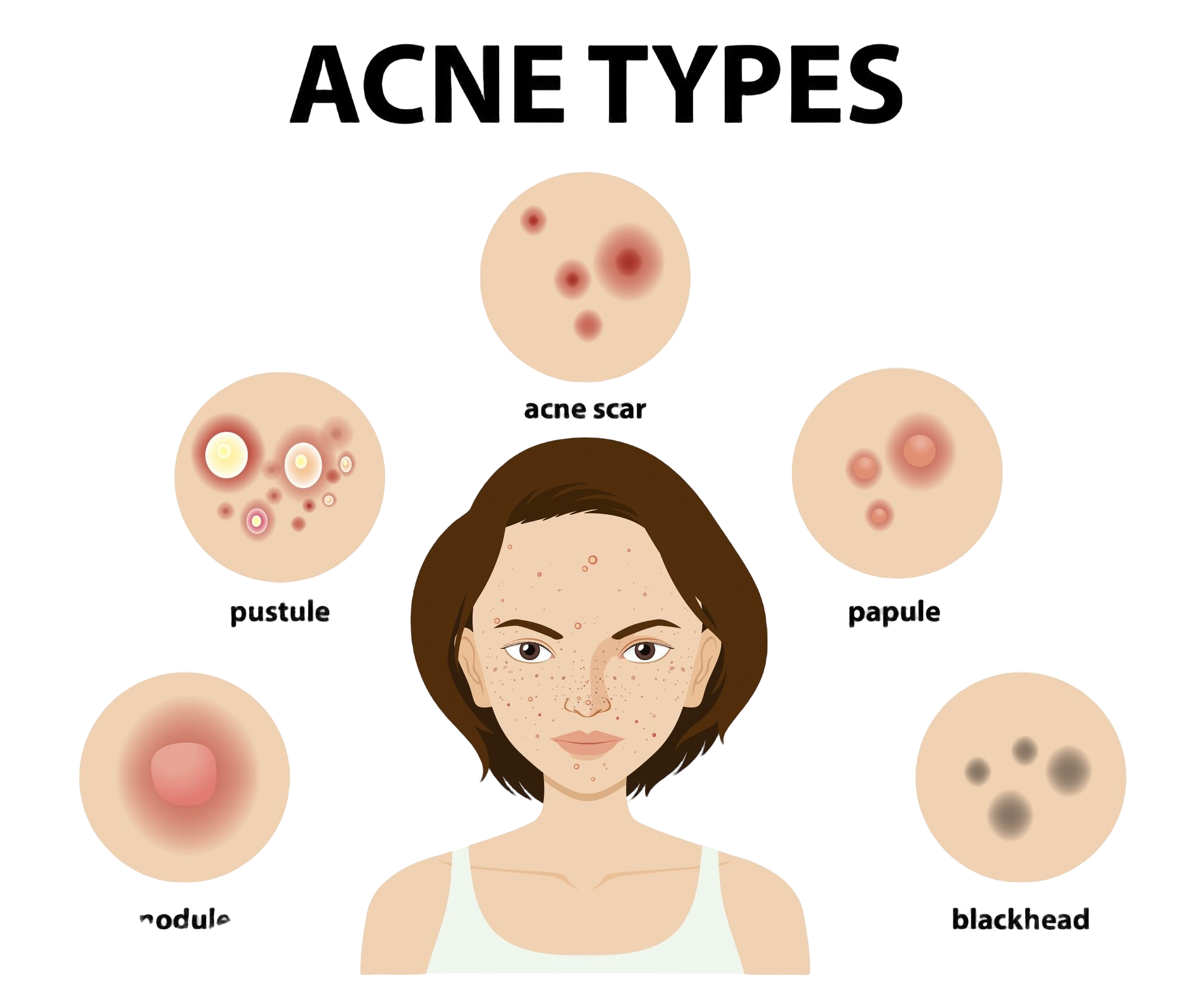 Let’s Talk About Acne! 💖 (And How to Manage It like a Skincare Pro)